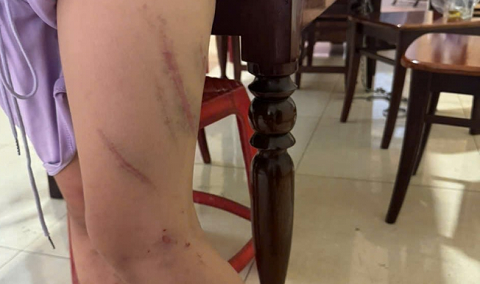 Công an xác minh vụ bé gái 9 tuổi bị đánh chi chít vết thương trên người
