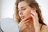Chăm sóc da mụn hiệu quả trong thời tiết hanh khô của mùa Thu