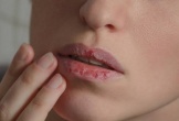Vì sao môi dễ nứt nẻ vào mùa Thu và nên khắc phục thế nào?