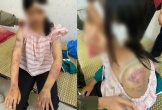Bé gái 13 tuổi bị bà nội tra khảo, đánh đập dã man, người chi chít vết thương
