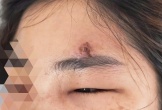 Tự nặn mụn, người phụ nữ ở Hà Nội bất ngờ rơi vào nguy kịch